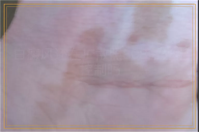 白癜风还在扩散照308激光能控制吗