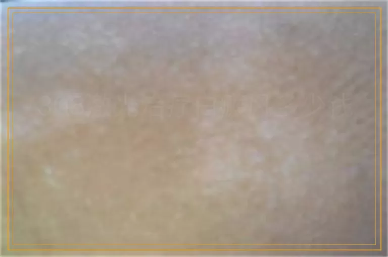 308激光治疗白癜风多少钱