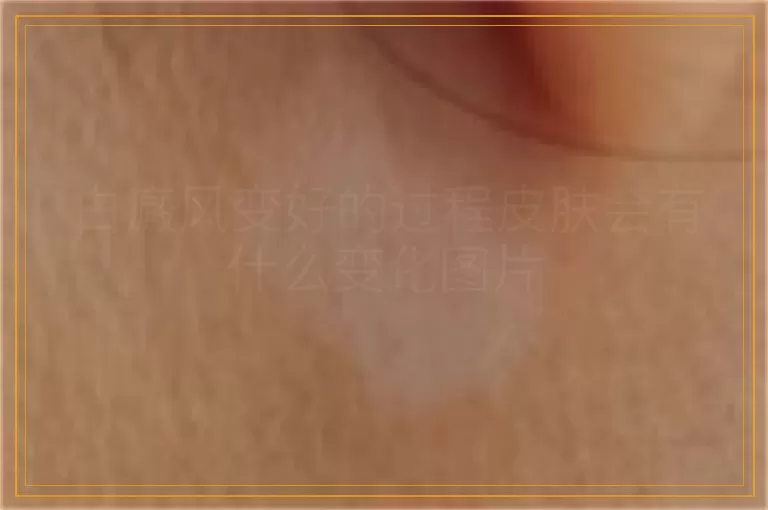 白癜风变好的过程皮肤会有什么变化图片