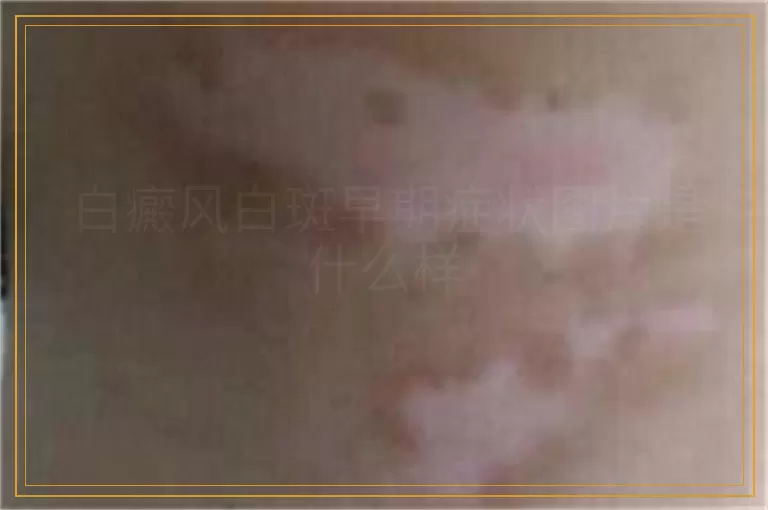 白癜风白斑早期症状图片是什么样