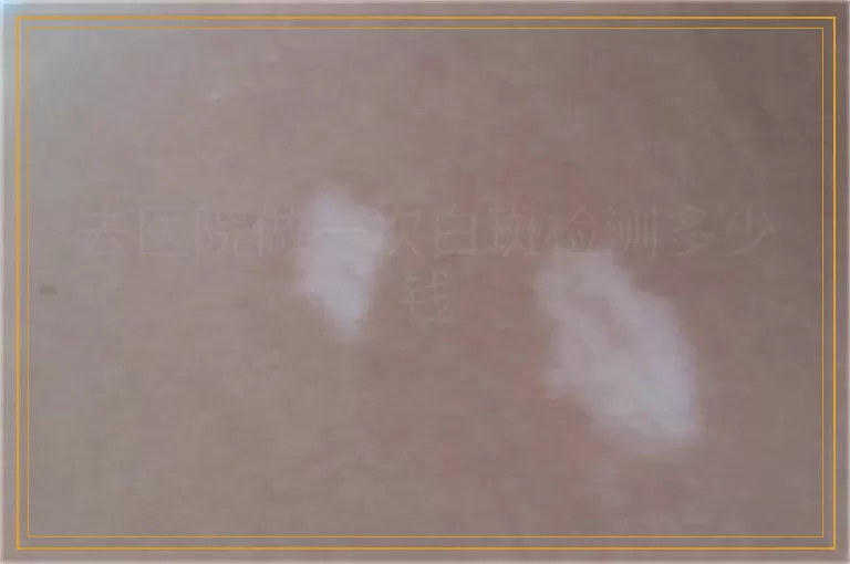 去医院做一次白斑检测多少钱