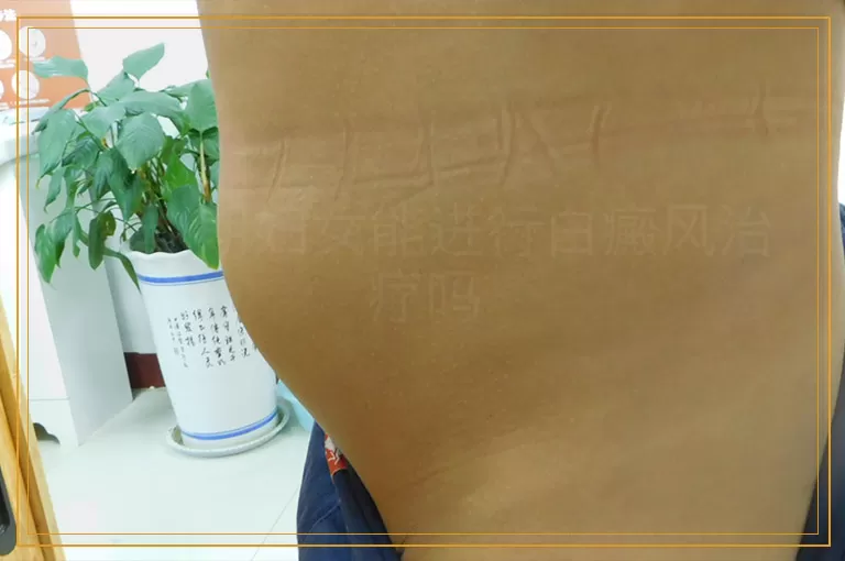 哺乳期妇女能进行白癜风治疗吗