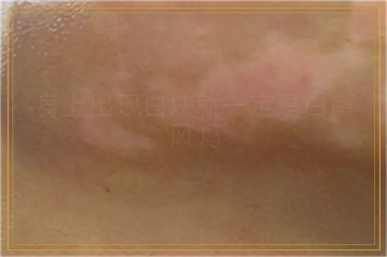 身上出现白块就一定是白癜风吗