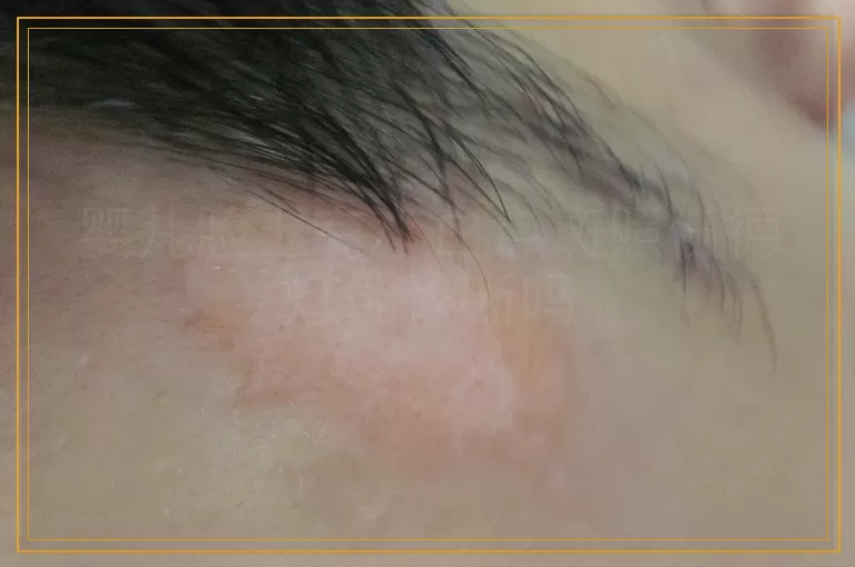 婴儿脸上有小白点斑照伍德灯能诊断吗
