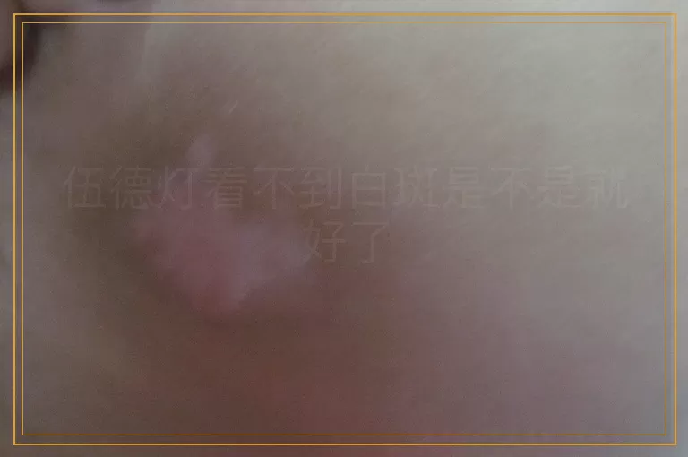 伍德灯看不到白斑是不是就好了