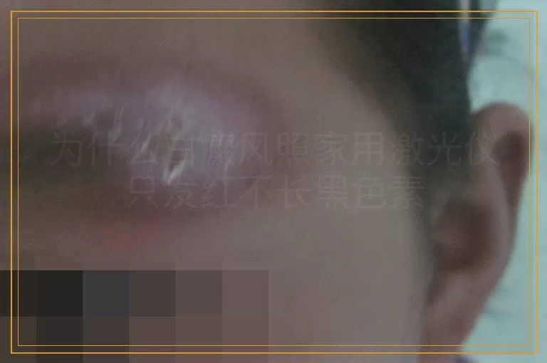 为什么白癜风照家用激光仪只发红不长黑色素