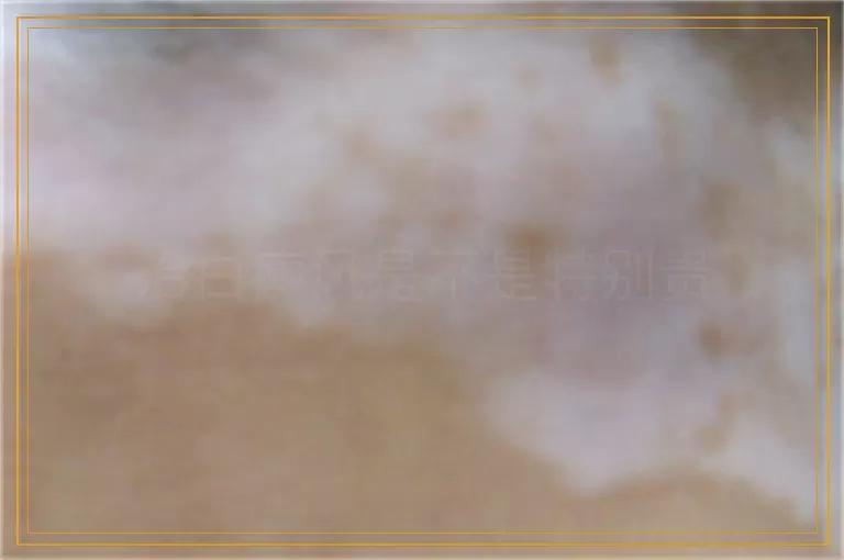 治白癜风是不是特别贵