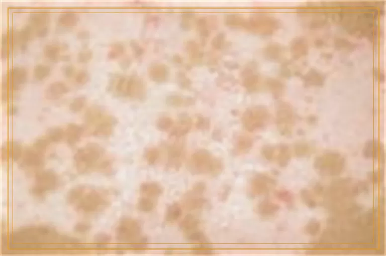 308nm准分子激光能照眼皮上白癜风吗