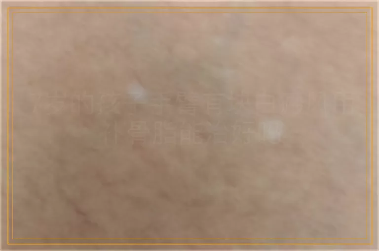 7岁的孩子手臂有块白癜风用补骨脂能治好吗
