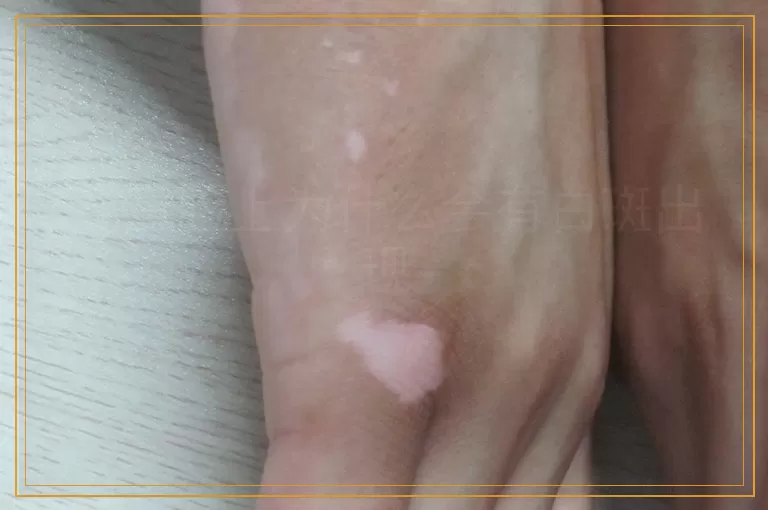 儿童脸上为什么会有白斑出现