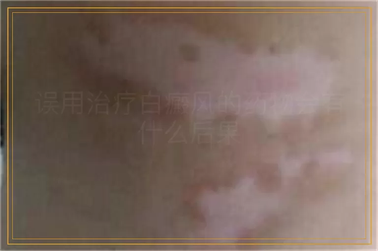 误用治疗白癜风的药物会有什么后果