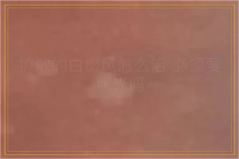 扩散的白癜风怎么治 必须要照光吗