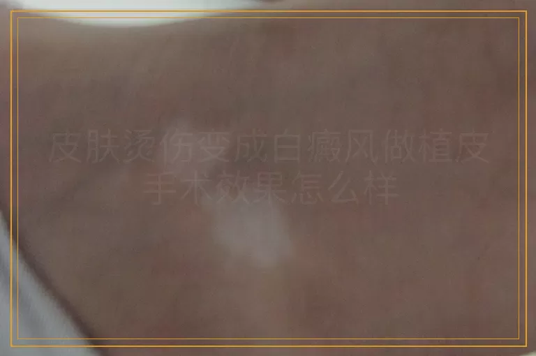 皮肤烫伤变成白癜风做植皮手术效果怎么样