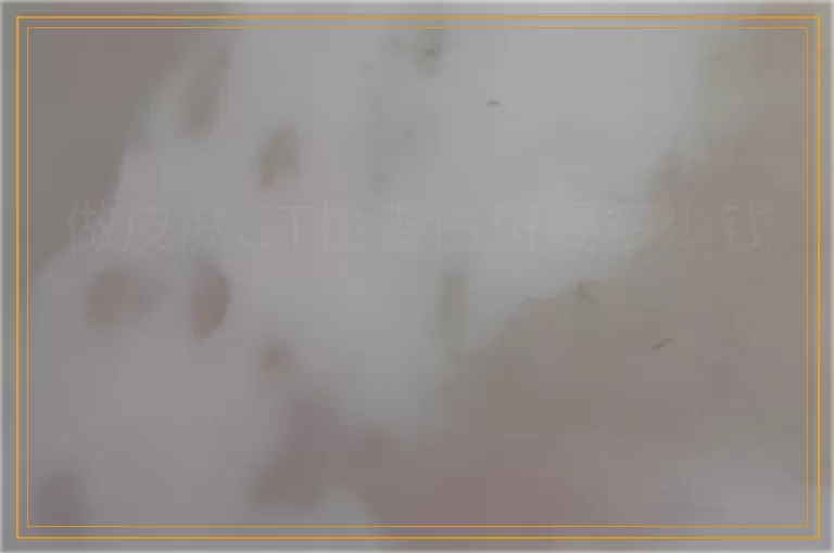 做皮肤CT检查白斑要多少钱