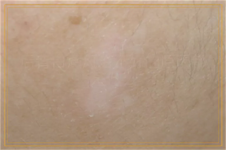 后背白癜风治不好的原因都是什么