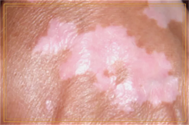 肚子腰上长白斑如何确定是不是白癜风