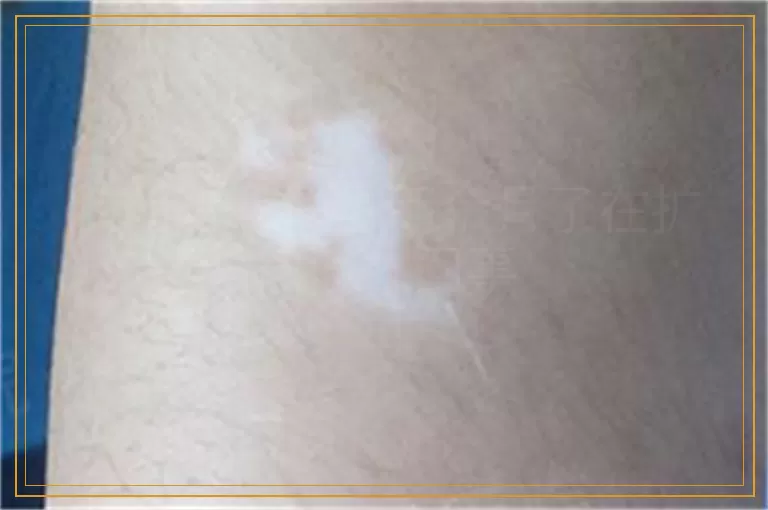 胸前有一块白两个月了在扩散怎么回事