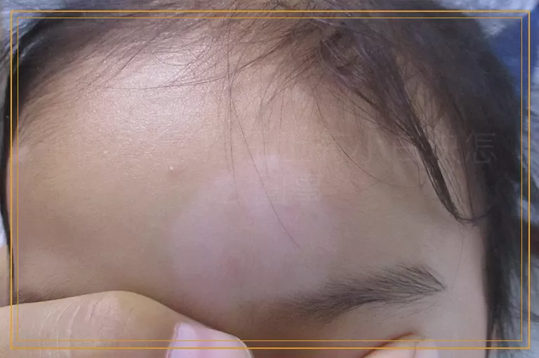 11岁女孩脖子上有小白块怎么回事