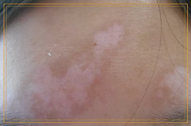 4个月宝宝大腿边上长白斑是什么原因