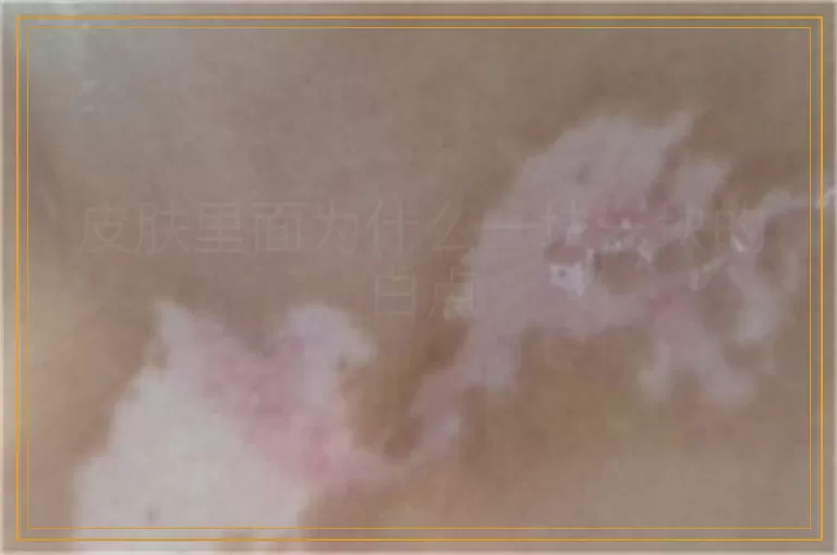 皮肤里面为什么一块一块的白点