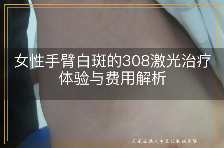 女性手臂白斑的308激光治疗体验与费用解析