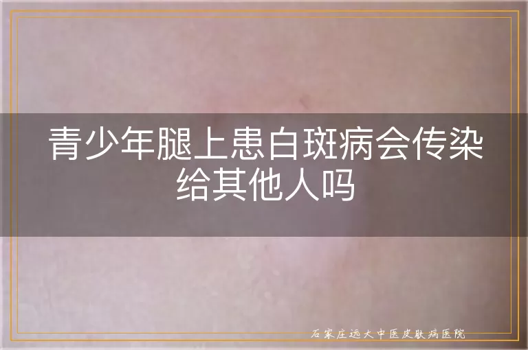 青少年腿上患白斑病会传染给其他人吗