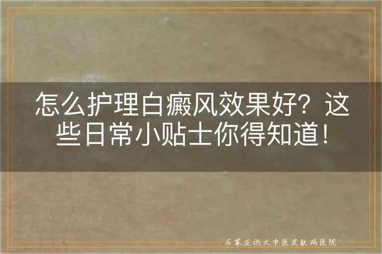 怎么护理白癜风效果好？这些日常小贴士你得知道！