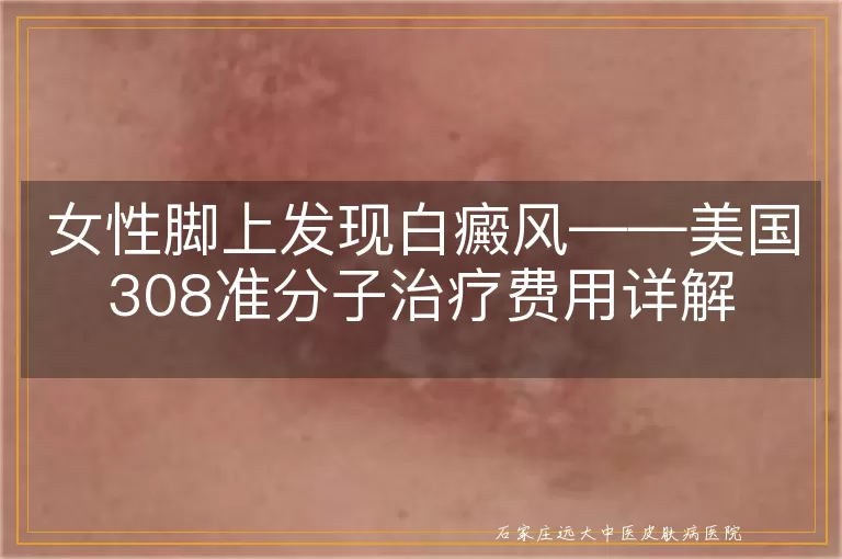 女性脚上发现白癜风——美国308准分子治疗费用详解
