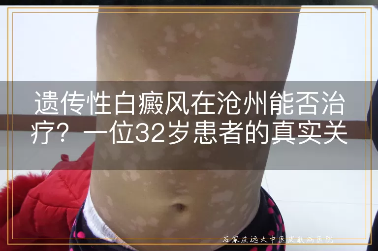 遗传性白癜风在沧州能否治疗？一位32岁患者的真实关切