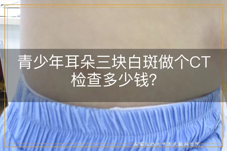 青少年耳朵三块白斑做个CT检查多少钱？