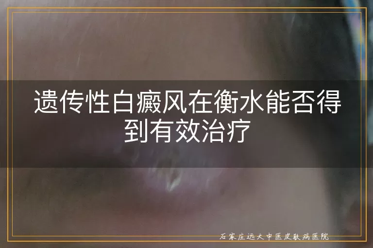 遗传性白癜风在衡水能否得到有效治疗