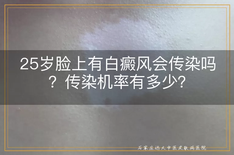 25岁脸上有白癜风会传染吗？传染机率有多少？