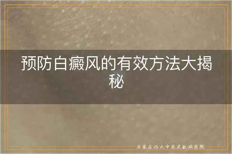 预防白癜风的有效方法大揭秘