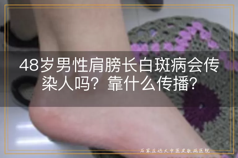 48岁男性肩膀长白斑病会传染人吗？靠什么传播？