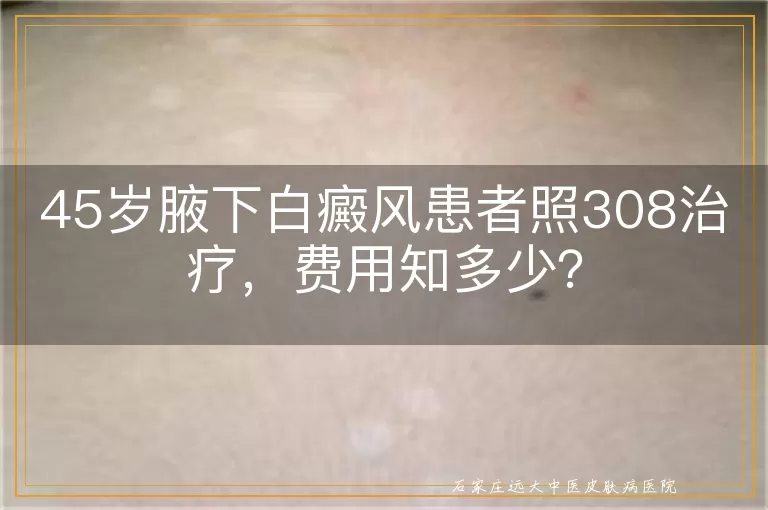 45岁腋下白癜风患者照308治疗，费用知多少？