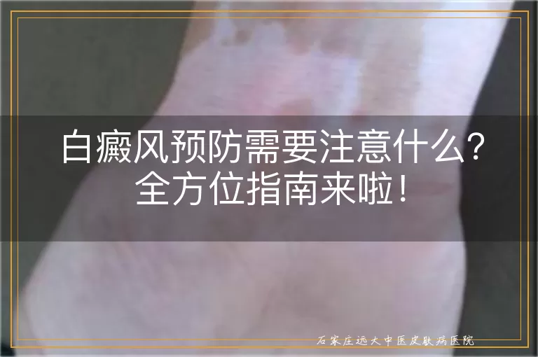 白癜风预防需要注意什么？全方位指南来啦！