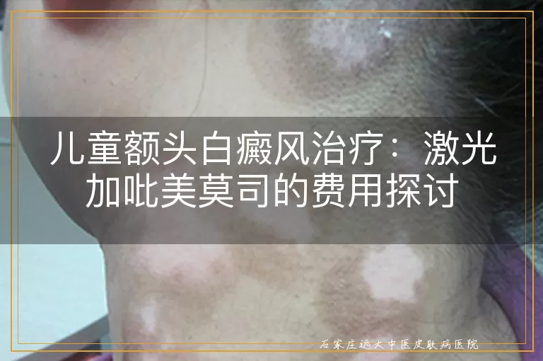 儿童额头白癜风治疗：激光加吡美莫司的费用探讨