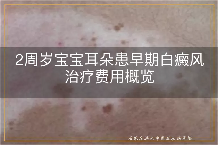 2周岁宝宝耳朵患早期白癜风治疗费用概览
