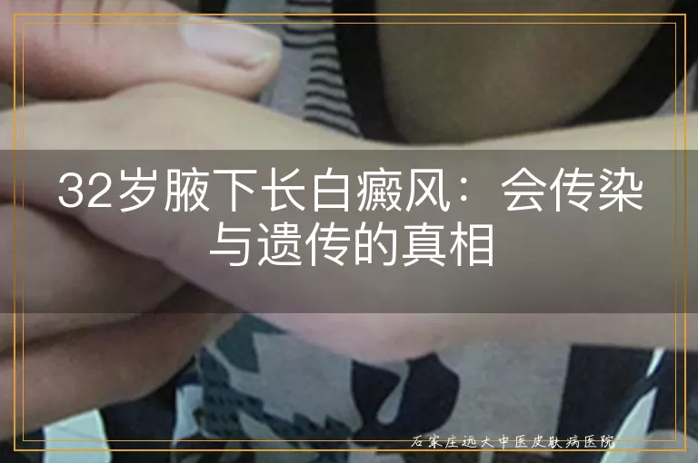 32岁腋下长白癜风：会传染与遗传的真相