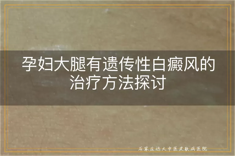 孕妇大腿有遗传性白癜风的治疗方法探讨