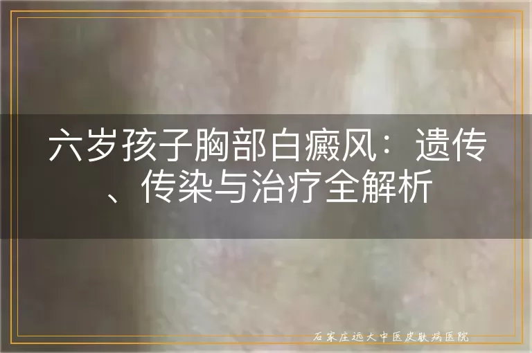 六岁孩子胸部白癜风：遗传、传染与治疗全解析
