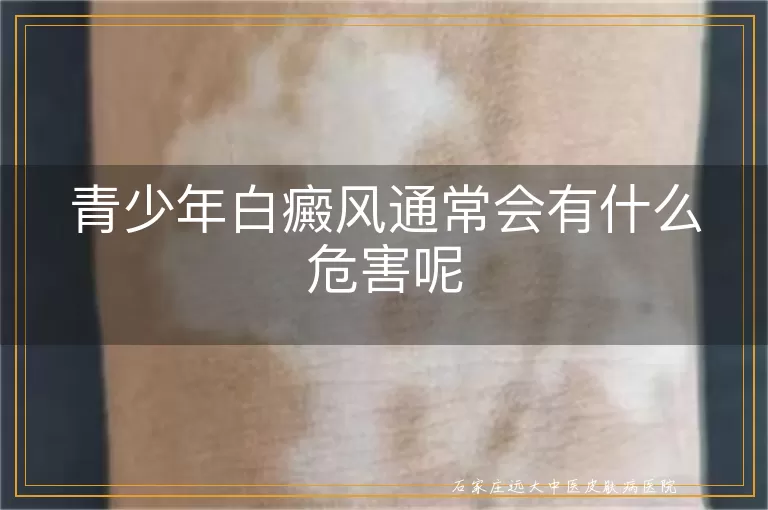 青少年白癜风通常会有什么危害呢