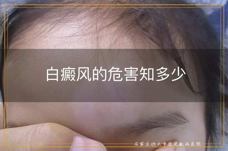 白癜风的危害知多少