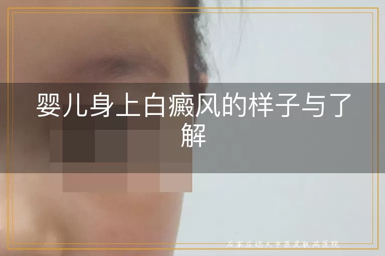 婴儿身上白癜风的样子与了解