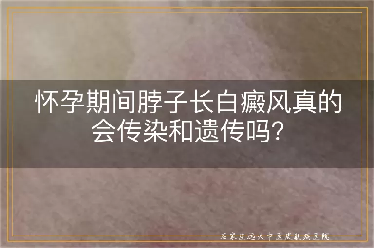 怀孕期间脖子长白癜风真的会传染和遗传吗？