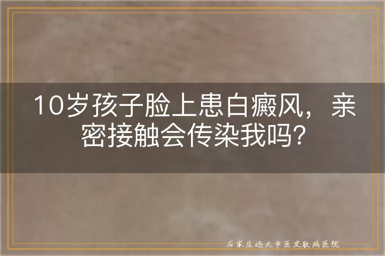 10岁孩子脸上患白癜风，亲密接触会传染我吗？