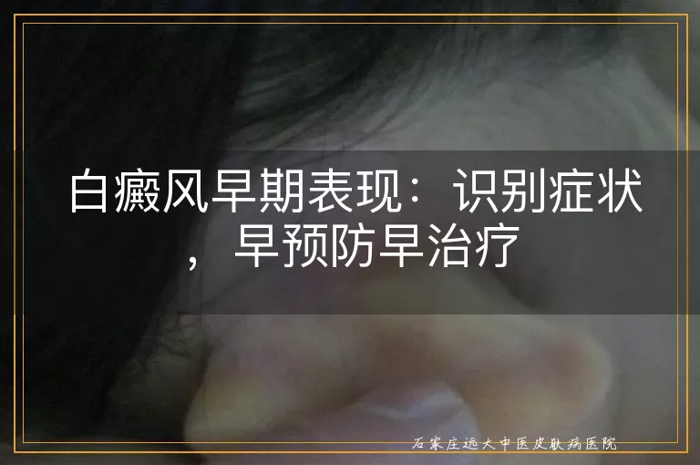 白癜风早期表现：识别症状，早预防早治疗