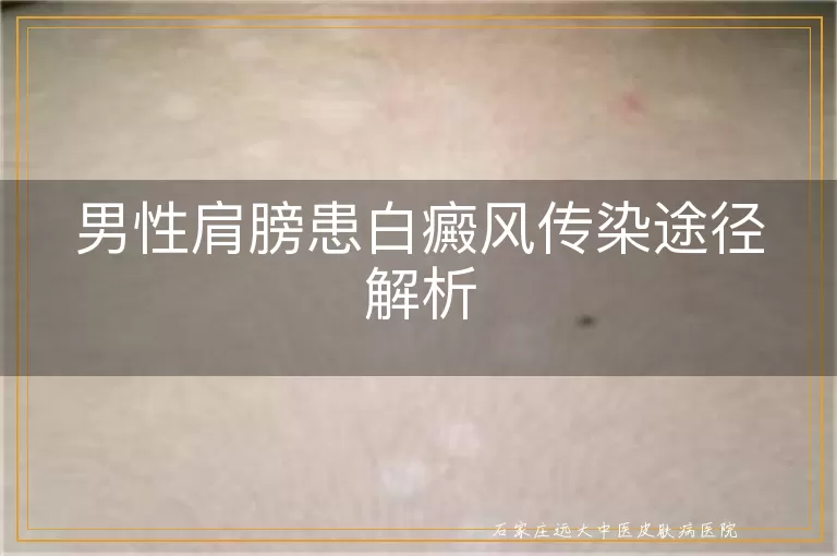 男性肩膀患白癜风传染途径解析