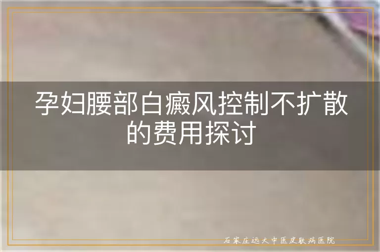 孕妇腰部白癜风控制不扩散的费用探讨