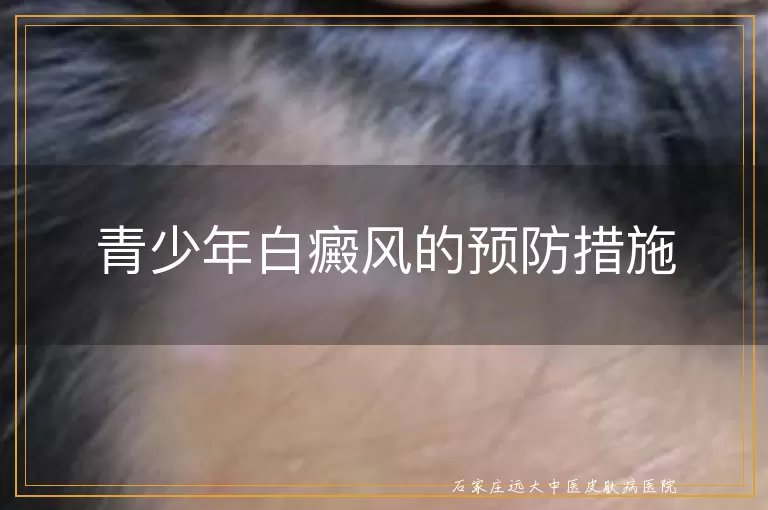 青少年白癜风的预防措施